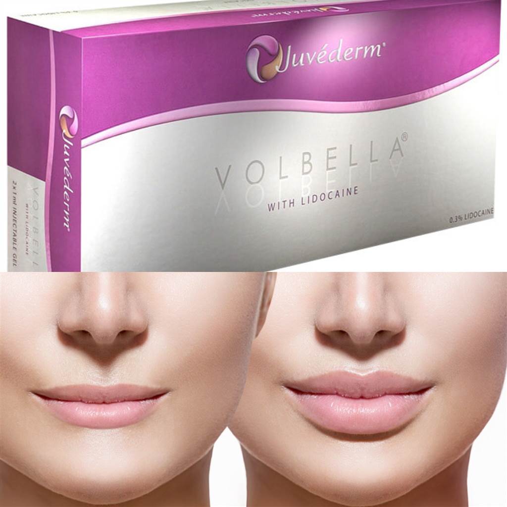 Juvéderm Volbella (2 x 1mI) - XQ-Shop