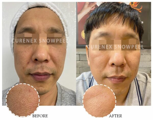 Curenex - SNOWPEEL C-Tox Peel - Image 5