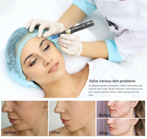 Dr. Pen A8S Ultima Pro Microneedling Pen - Image 2