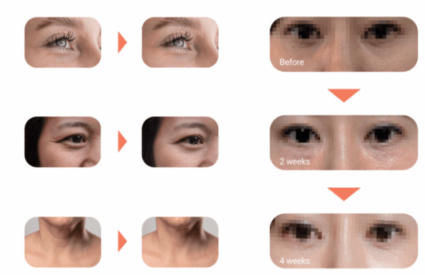 Eyebella - PN Skin Booster - Image 3