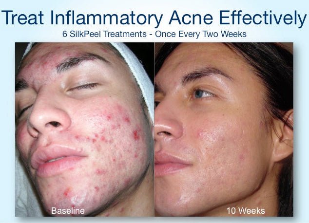 OR`JADE Silky Peel (AHA 30%) 2Xq-VIP OR`JADE Silky Peel (AHA 30%) - Image 2