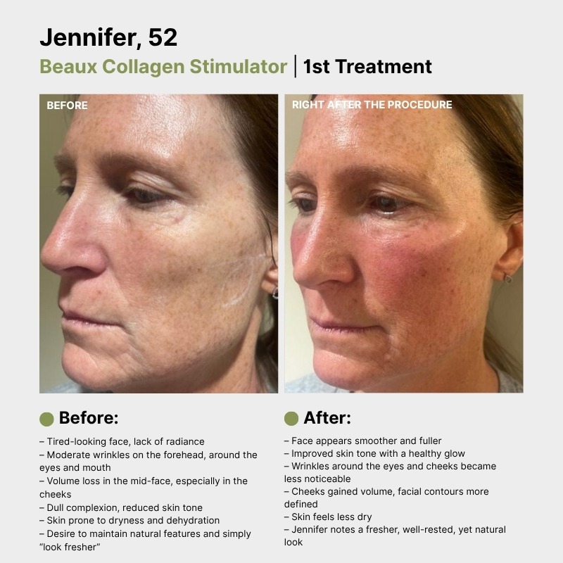 BEAUX (PDLLA + HA) 150mg 6Xq-VIP BEAUX (PDLLA + HA) 150mg Xq-VIP