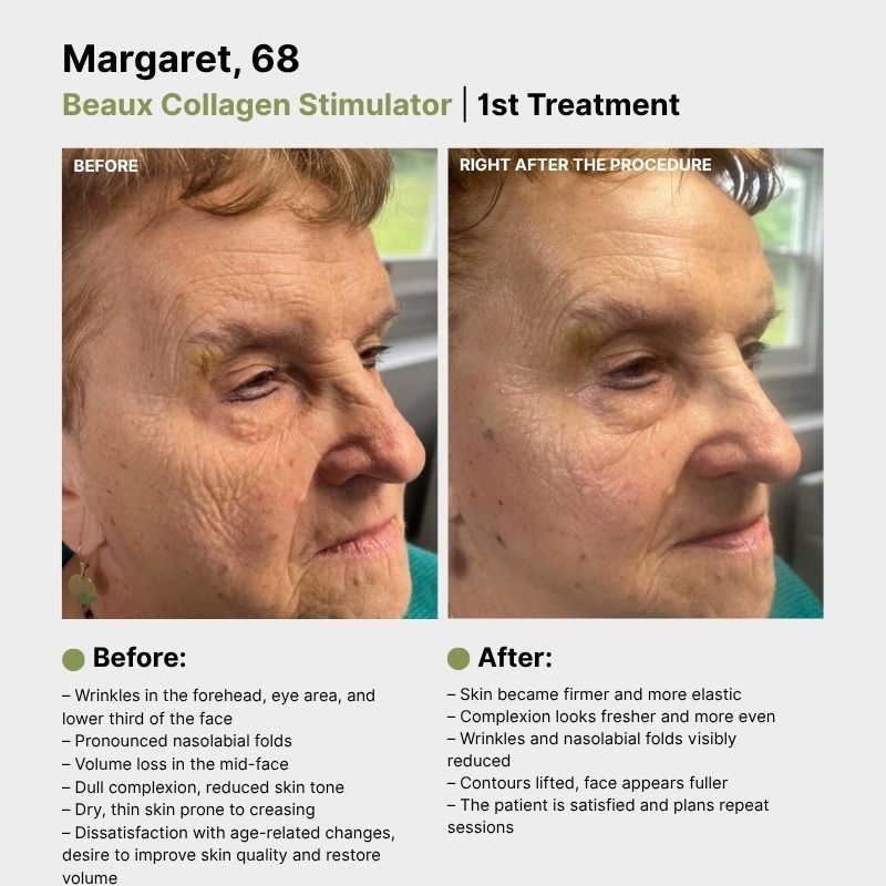 BEAUX (PDLLA + HA) 150mg Xq-VIP