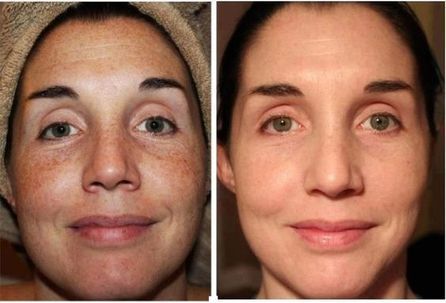 Melalite Forte Hydroquinone Cream 4% — Abbott Labs 30g 3Xq-VIP Melalite Forte Hydroquinone Cream 4% — Abbott Labs 30g - Image 3