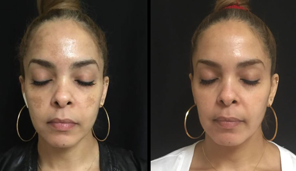 Melalite Forte Hydroquinone Cream 4% — Abbott Labs 30g 2Xq-VIP Melalite Forte Hydroquinone Cream 4% — Abbott Labs 30g - Image 2